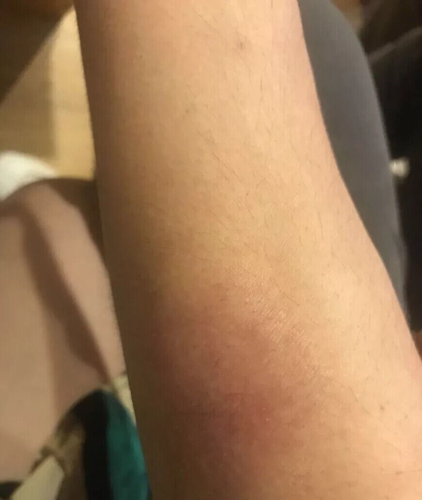 Moisturising Psoriasis Eczema Treatment Cream Skin Dermatitis Skincare Ointment