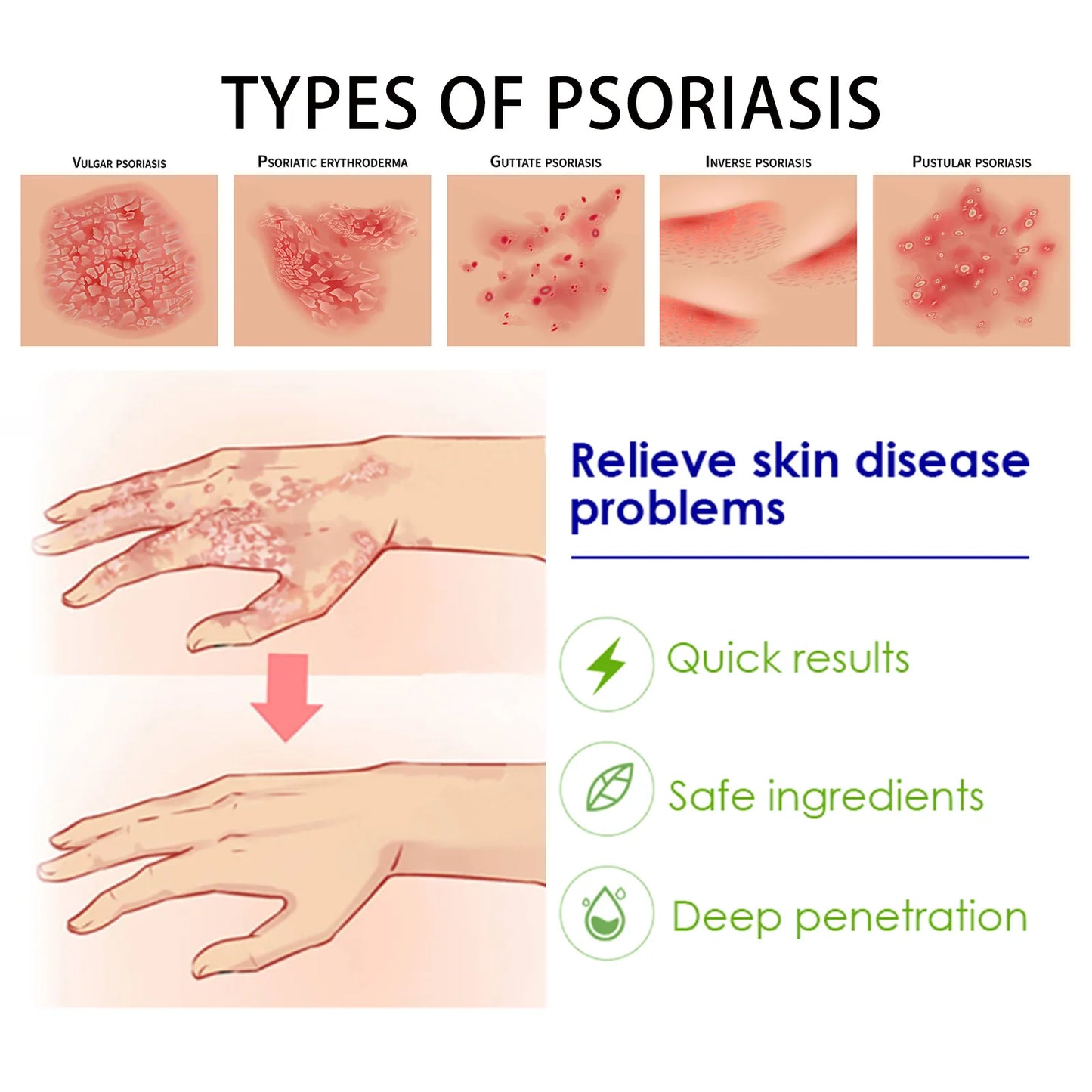 Moisturising Psoriasis Eczema Treatment Cream Skin Dermatitis Skincare Ointment
