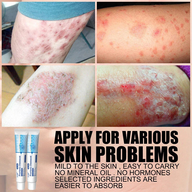 Psoriasis Cream for Dermatitis Eczematoid Eczema Natural Treatment Skin Ointment