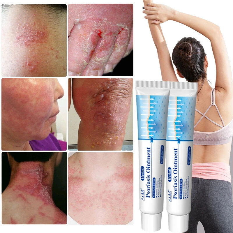 Psoriasis Cream for Dermatitis Eczematoid Eczema Natural Treatment Skin Ointment