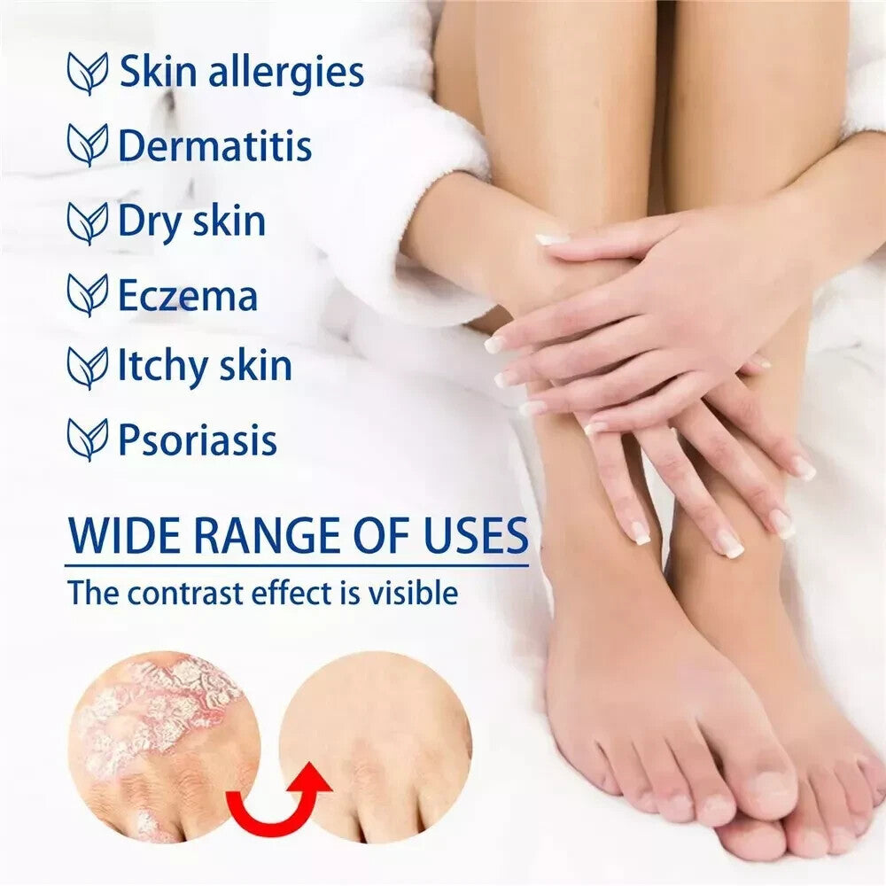 Psoriasis Cream for Dermatitis Eczematoid Eczema Natural Treatment Skin Ointment