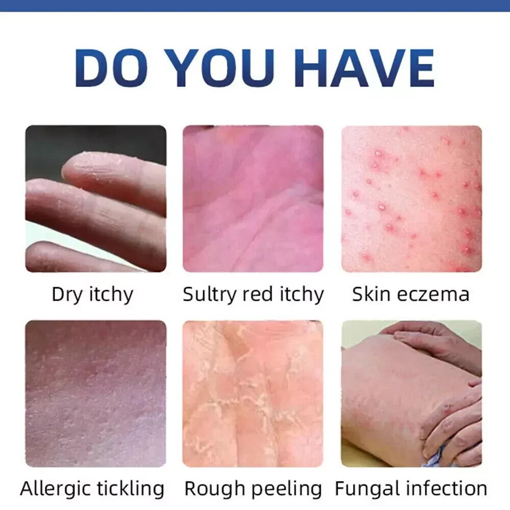 Psoriasis Cream for Dermatitis Eczematoid Eczema Natural Treatment Skin Ointment