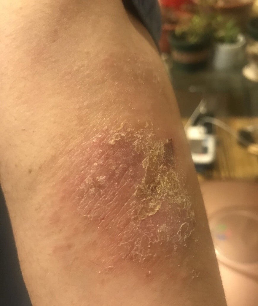 Psoriasis Cream for Dermatitis Eczematoid Eczema Natural Treatment Skin Ointment