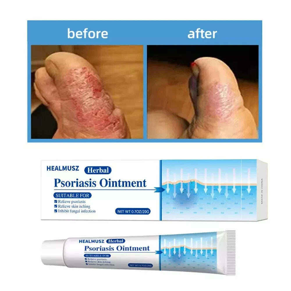 Psoriasis Cream for Dermatitis Eczematoid Eczema Natural Treatment Skin Ointment